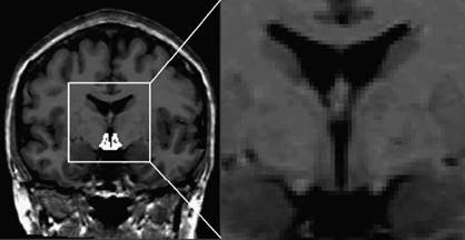 Transsexual brain hormones